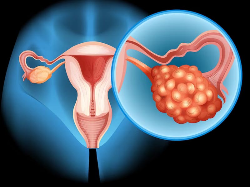 What is Polycystic ovary syndrome - PCOS
