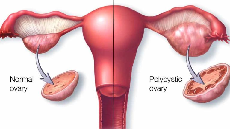 Identifying 10 Common Symptoms of PCOS