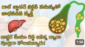 Gallbladder Stones Success Story