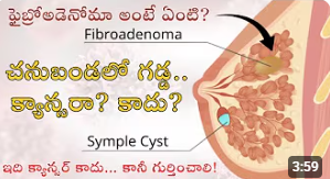 Fibroadenoma | lump in your breast?